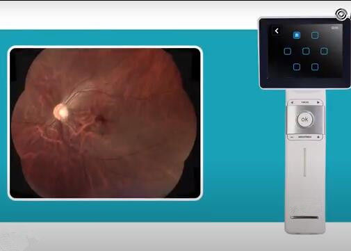 2560 X 1920 Pixels Digital Fundus Camera