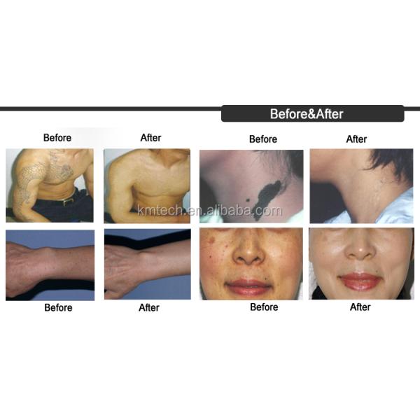 4 Wavelengths Nd YAG Q Switch Laser Machine Tattoo Removal Stationary Style