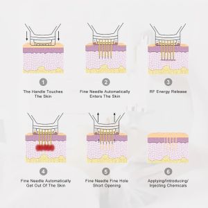 Fractional Professional RF Microneedling Devices Face Lift Skin Tightening Micro