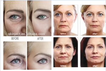 Cross Linked Dermal Filler LYFT For Forehead Lines Filling