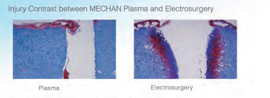 Mechan New Generation of Plasma Generator for Minimally Invasive ENT Surgery -Turbinate Channeling and Ablation