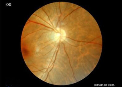 Android System For Easier Operation Hand-held Fundus Camera With Minimum Pupil 2.5mm Image Resolution 1920x1080