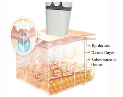 Portable fractional RF microneedle FRAXEL rf fractional microneedle machine