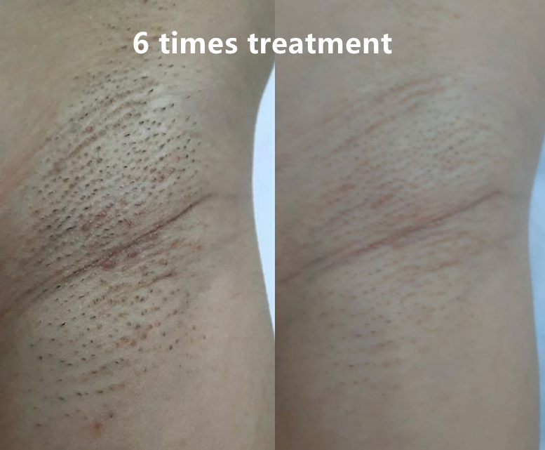 755 808 1064 Diode Laser Skin Hair Removal Device With 6-16 Laser Bars And Touch Screen