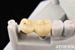 Experience Aesthetically Pleasing Results With Customizable Implant Retained