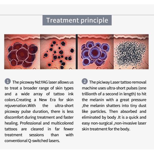 Professional Picosecond Laser Machine 755 1064nm Pico Laser Device For Pigment Tattoo Removal