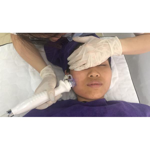 5Mhz Scar Removal Face Lifting Microneedle RF Machine