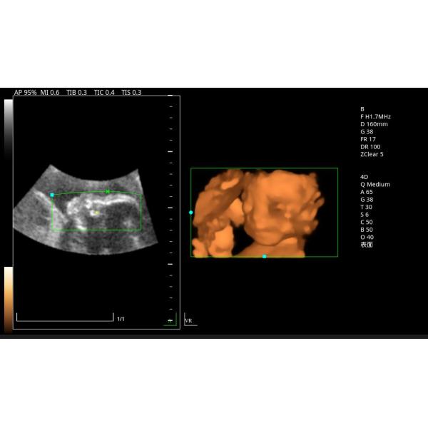 Zoncare 3D/4D Trolley Medical Digital Color Doppler Ultrasound System for Hospital