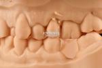 Customizable White Composite Inlay Onlay Natural Looking Minimally Invasive
