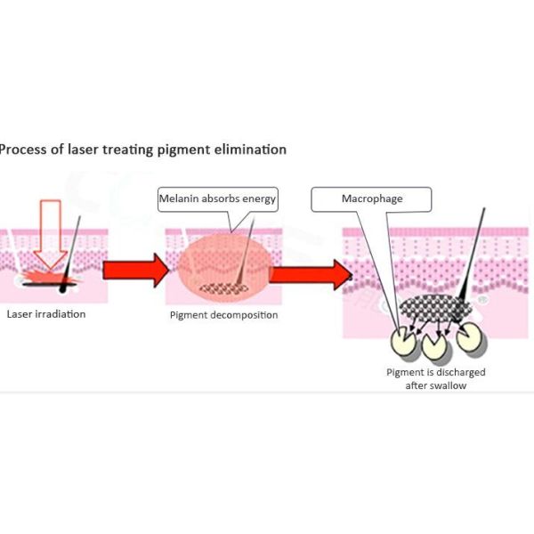Small 808nm Center Wavelength Laser Stack Ice Laser Press The Button Constant Spectral Output