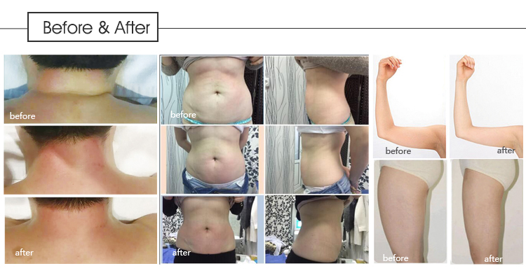 Professional Cellulite Treatment Machine OEM ODM Body Cellulite Removal Machine
