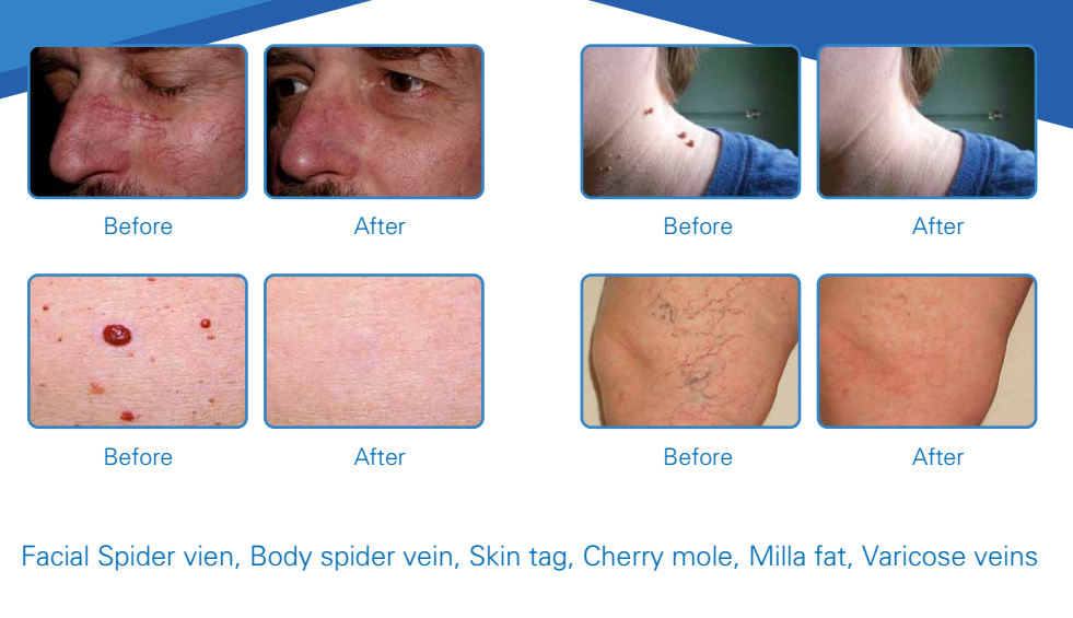 980nm diode laser spider vein removal machine laser varicose vein removal treatment