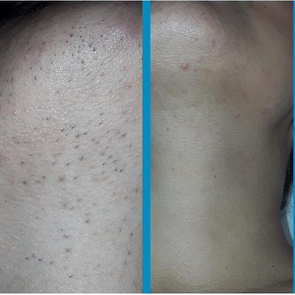 Commercial Portable Diode Laser Machine 808nm 755nm 1064nm 560D Laser Depilator