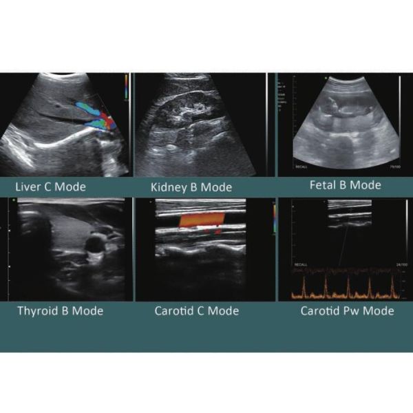 Usb Ultrasound Probe Android IOS Windows All Available Primary Care Handheld Ultrasound Scanner With 6 Languages