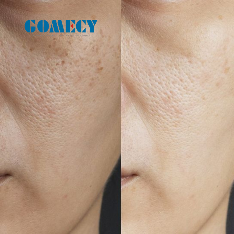 Blue Microneedle RF Machine for Scar Acne Wrinkle Removal 10-150mj/pin Energy Skin Tightening